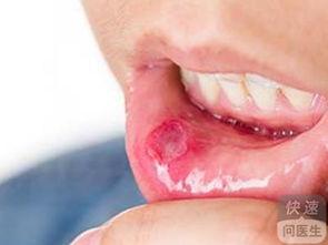 吃瓜口腔溃疡,口腔溃疡困扰？揭秘吃瓜与溃疡的微妙关系