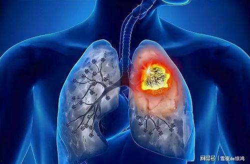 肺结节可以吃瓜吗,瓜类食物的适宜与禁忌