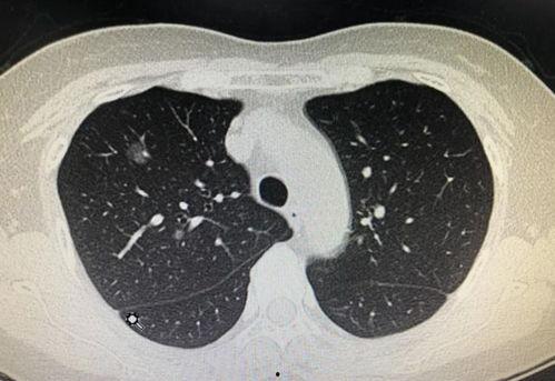 肺结节可以吃瓜吗,瓜类食物的适宜与禁忌
